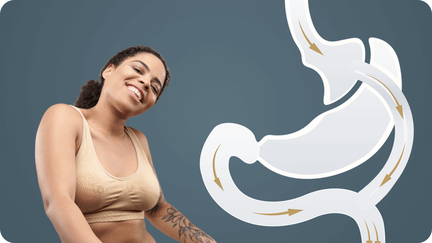 Happy woman with a diagram showing a revision of gastric bypass surgery