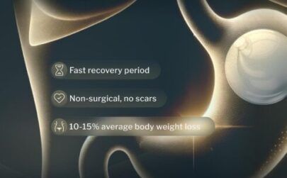 An illustration of a gastric balloon in a stoomach