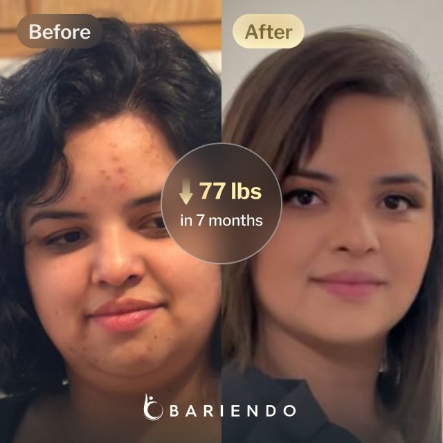 Before and after images of Nicole, a Bariendo ESG Stomach Tightening™ patient who lose 77 pounds in 7 months