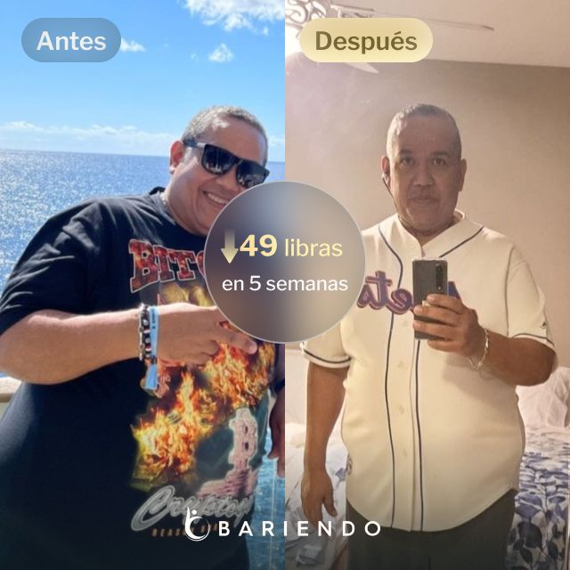 Imágenes de antes y después de César, quien perdió 49 libras en 5 meses mediante el procedimiento ESG Stomach Tightening™ de Bariendo